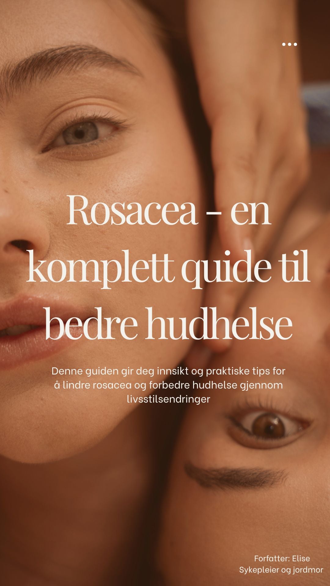 ROSACEA – En komplett guide til bedre hudhelse
